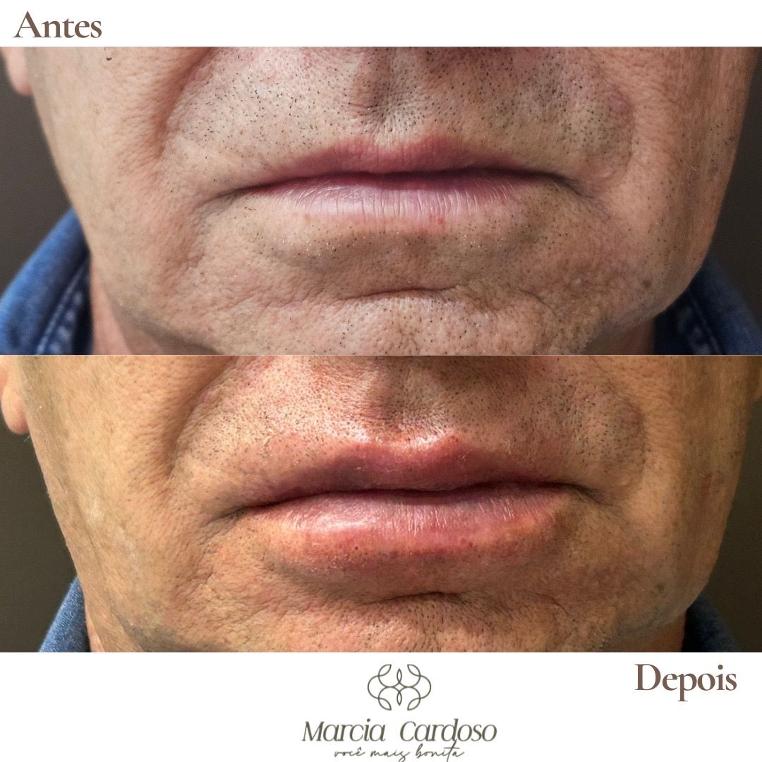 Comparativo de antes e depois em tratamento labial.