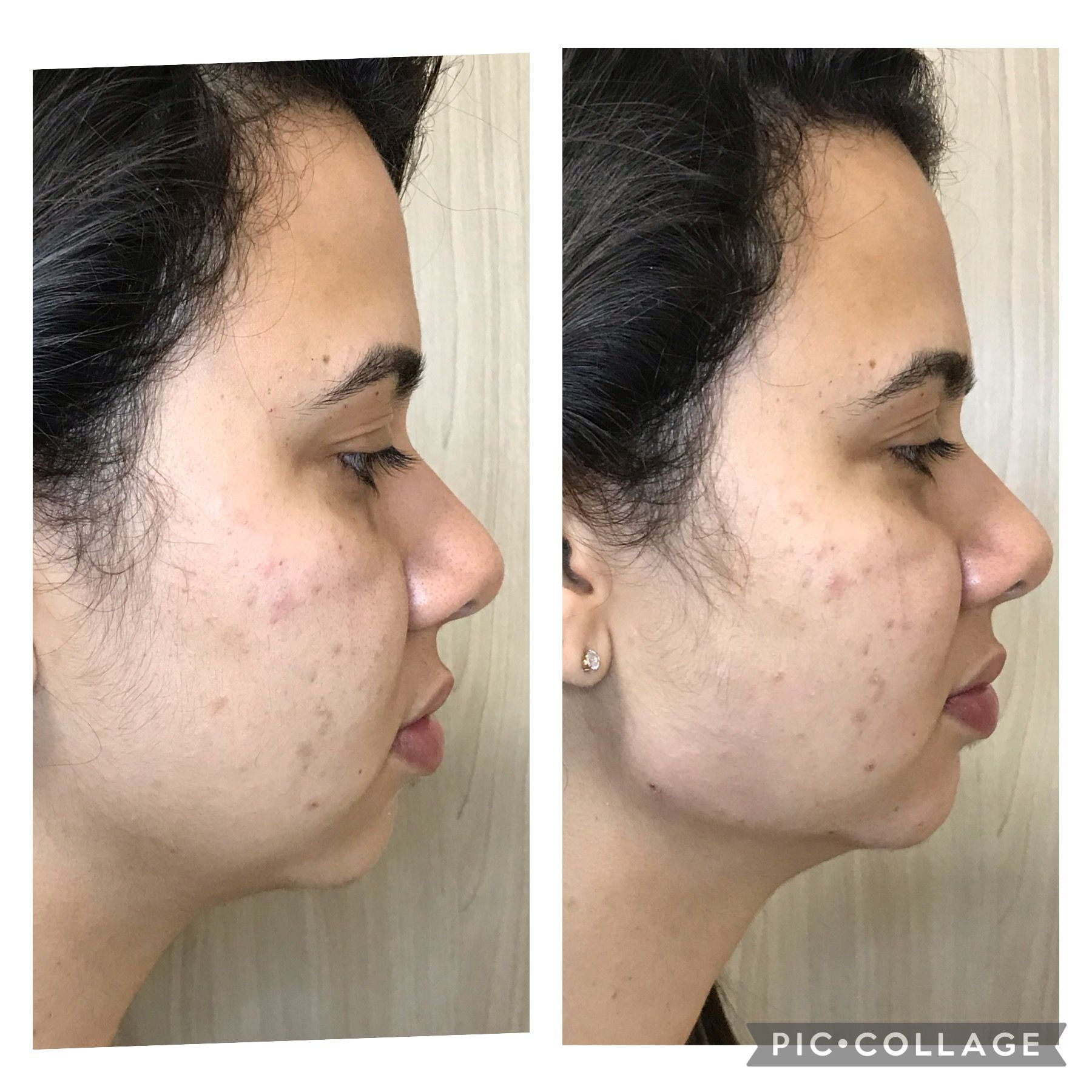 Comparativo de antes e depois em tratamento facial.